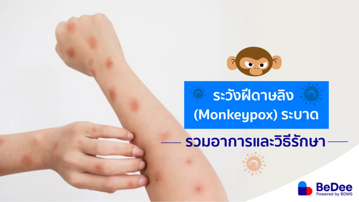 ฝีดาษลิงอันตรายหรือไม่? รวมวิธีรักษาและการป้องกัน