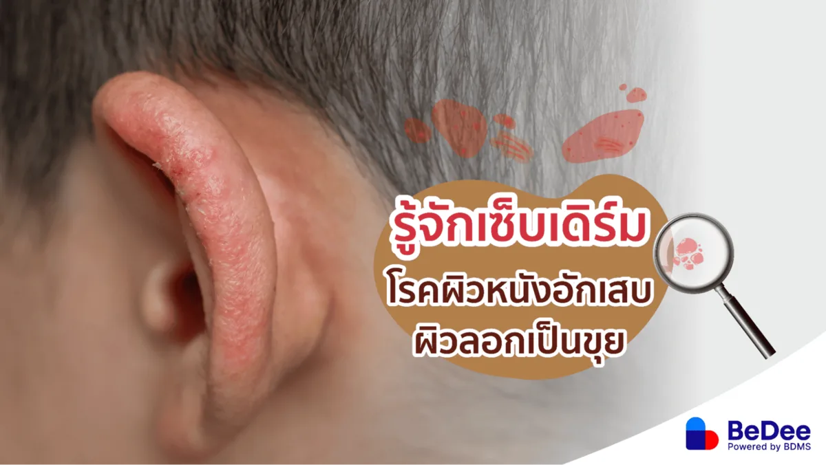 รู้จักเซ็บเดิร์ม โรคผิวหนังลอกเป็นขุย