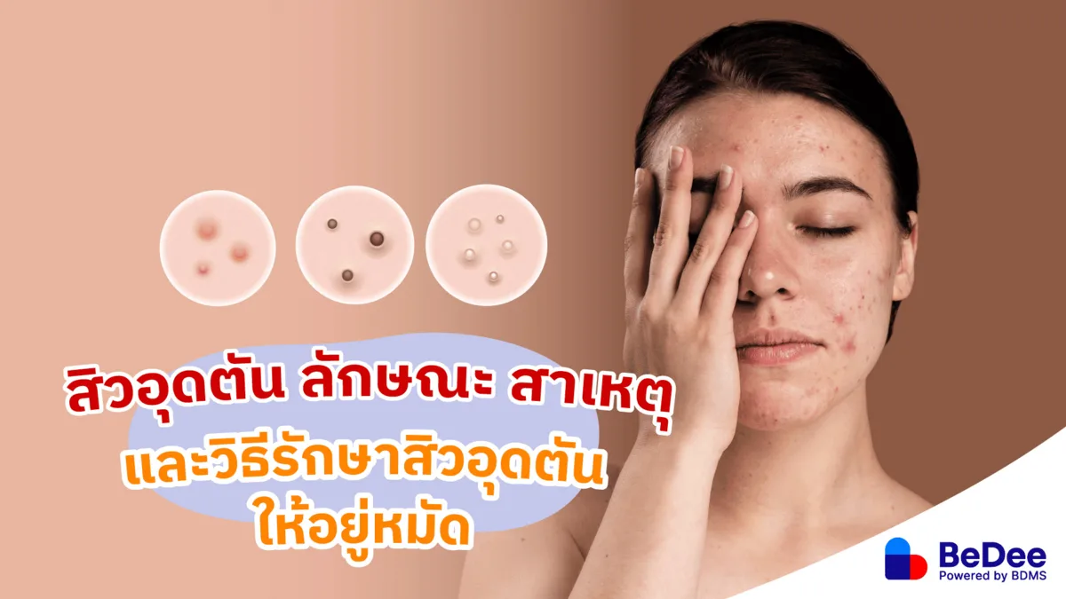 สิวอุดตัน (Comedones) ลักษณะอย่างไร สาเหตุและการรักษาที่ถูกต้อง