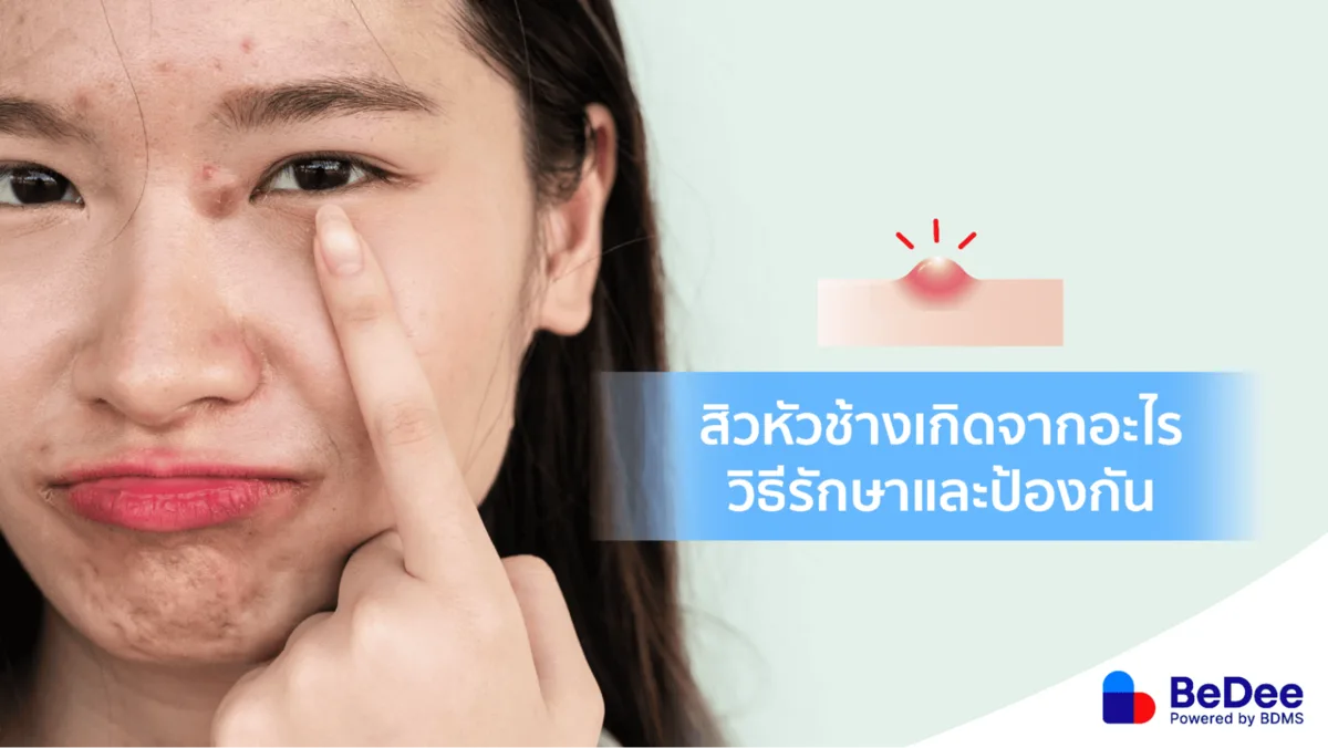 สิวหัวช้างจัดการและรับมืออย่างไรดี เมื่อหน้าพัง