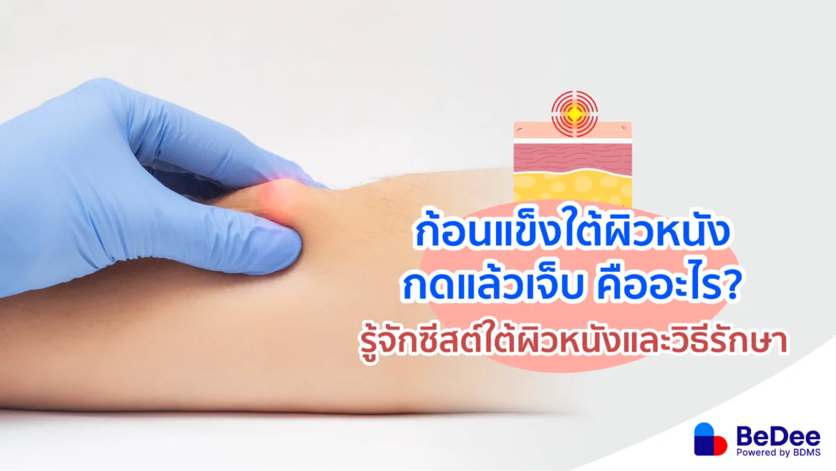 ก้อนแข็งใต้ผิวหนัง กดแล้วเจ็บคืออะไร อันตรายไหม?