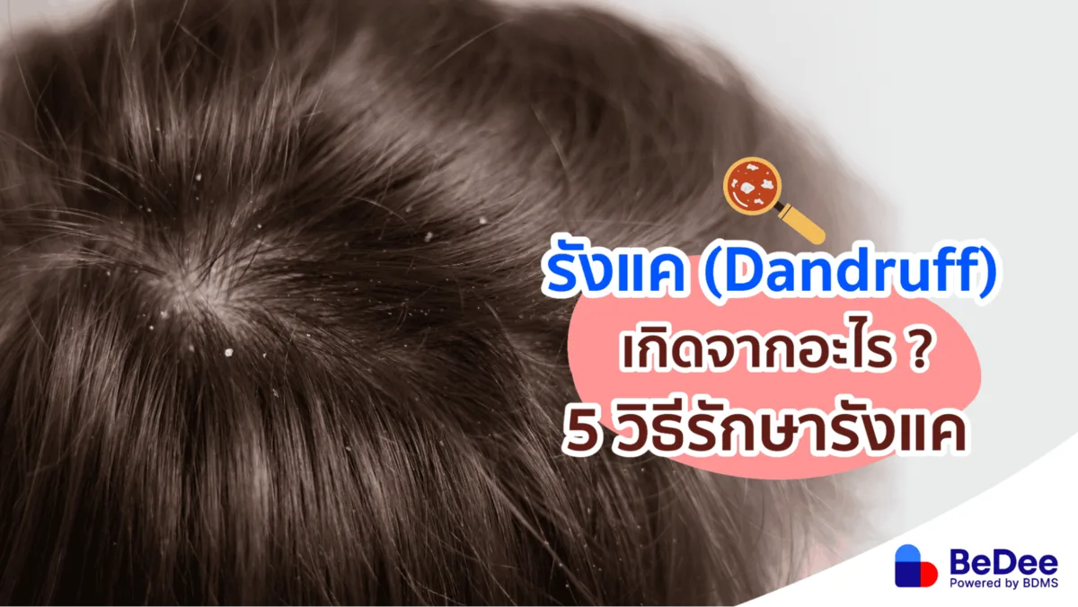 รังแคเกิดจากอะไร รู้จักและรับมือกับปัญหารังแคให้ตรงจุด
