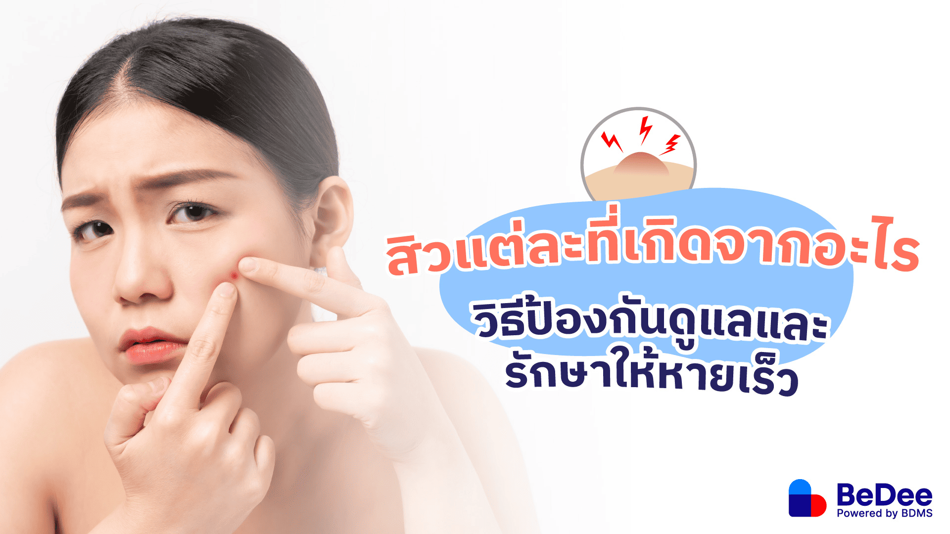สิวแต่ละที่เกิดจากอะไร วิธีป้องกันดูแลและรักษาให้หายเร็ว