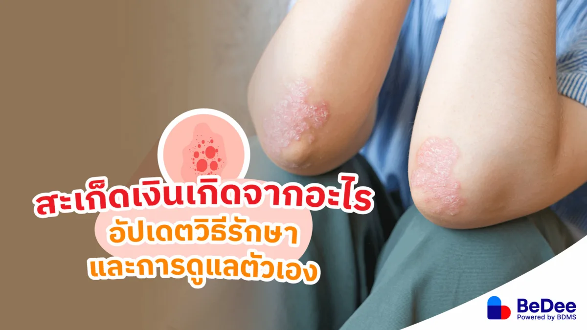 สะเก็ดเงินเกิดจากอะไร อัปเดตวิธีรักษาและการดูแลตัวเอง