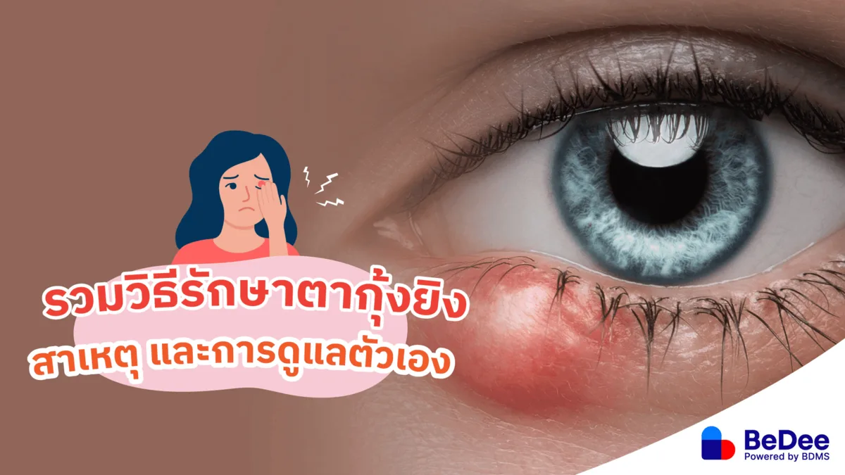 ตากุ้งยิงอาการเป็นอย่างไร สาเหตุ และวิธีรักษาตากุ้งยิงอย่างเร่งด่วน
