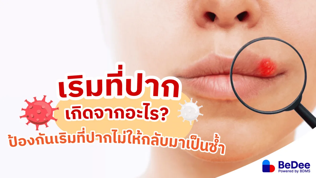 เริมที่ปากเกิดจากอะไร? รู้ทันสาเหตุ อาการ และวิธีรักษาเริมที่ปาก