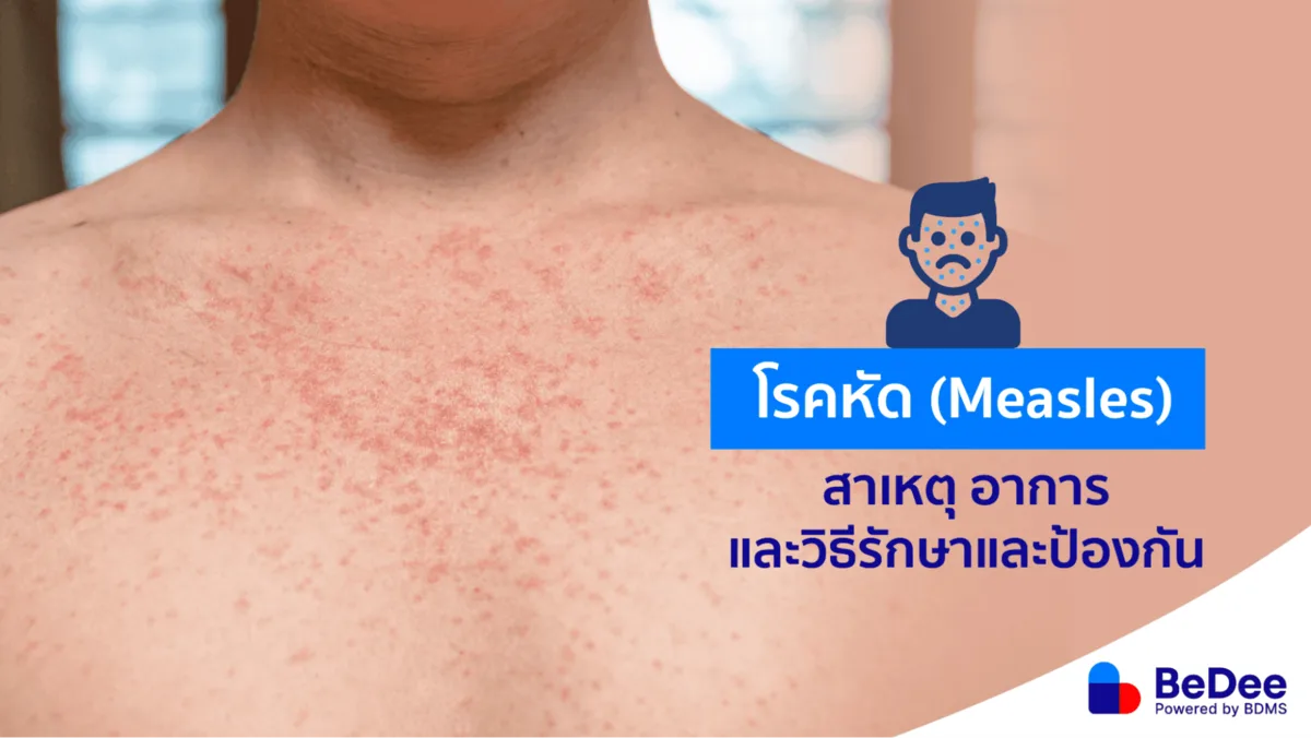 โรคหัด อาการ โรคแทรกซ้อน และวิธีป้องกัน