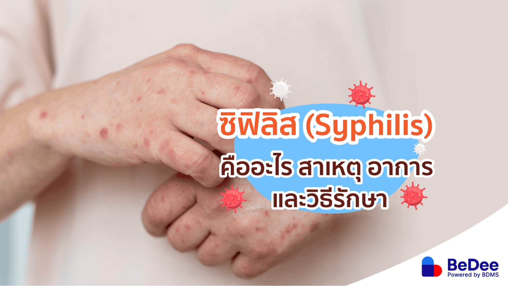 ซิฟิลิสโรคติดต่อทางเพศสัมพันธ์ที่แฝงตัวได้นานนับสิบปี