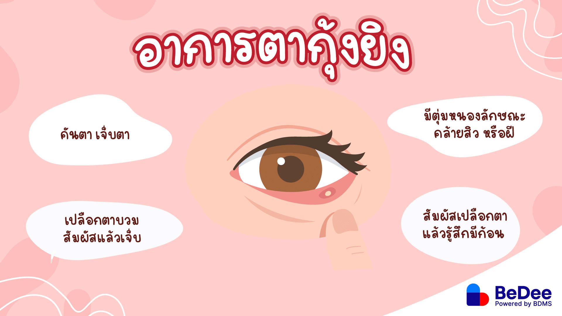 ตากุ้งยิงอาการเป็นอย่างไร