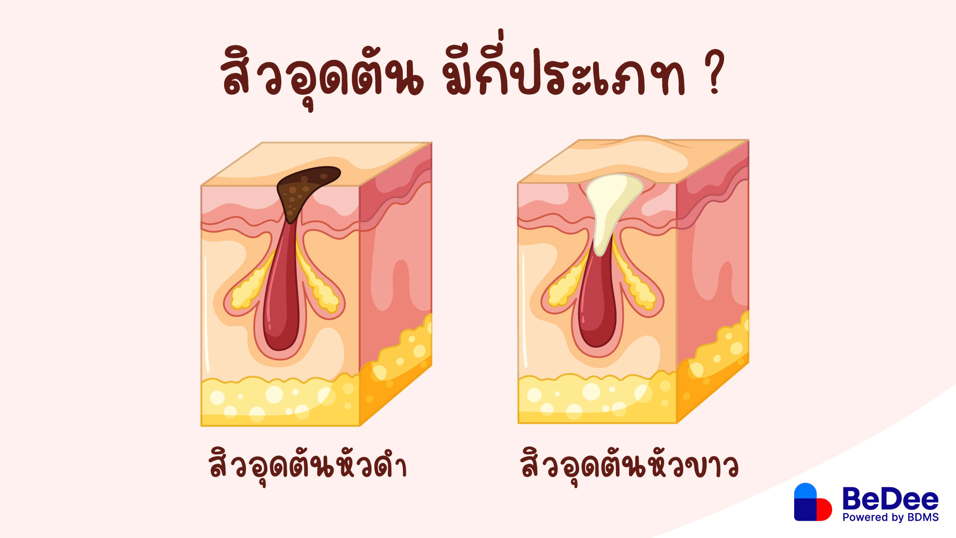 ประเภทของสิวอุดตัน